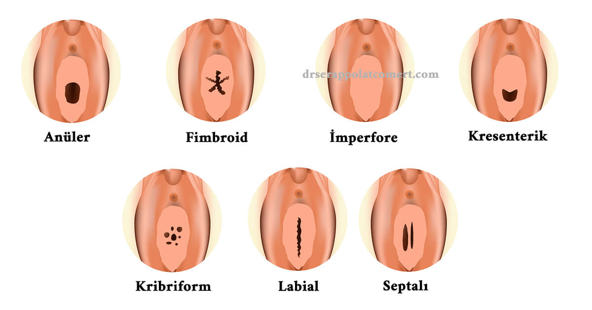 kızlık zarı dikimi